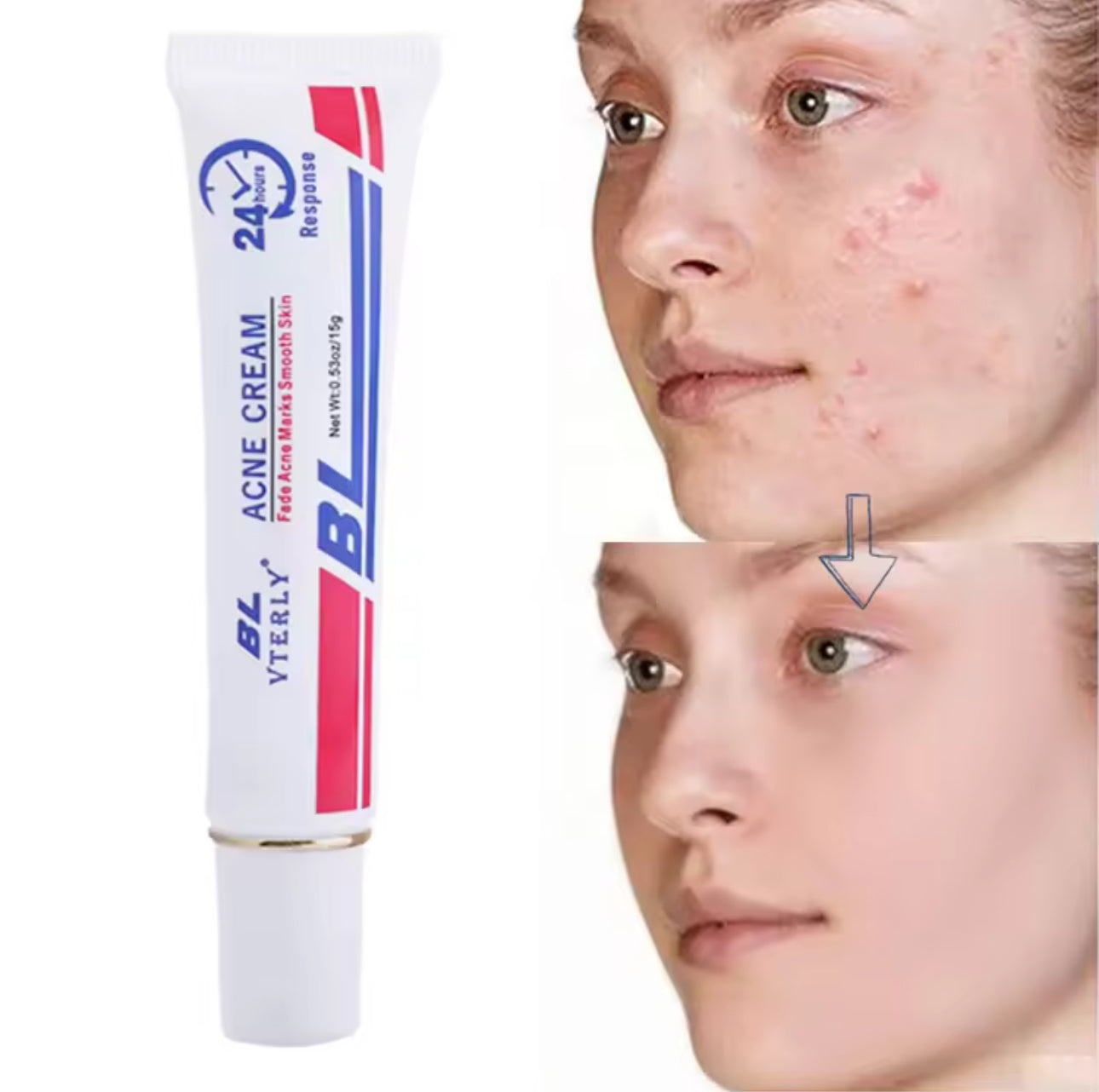 BL VTERLY Acne Cream | 20g