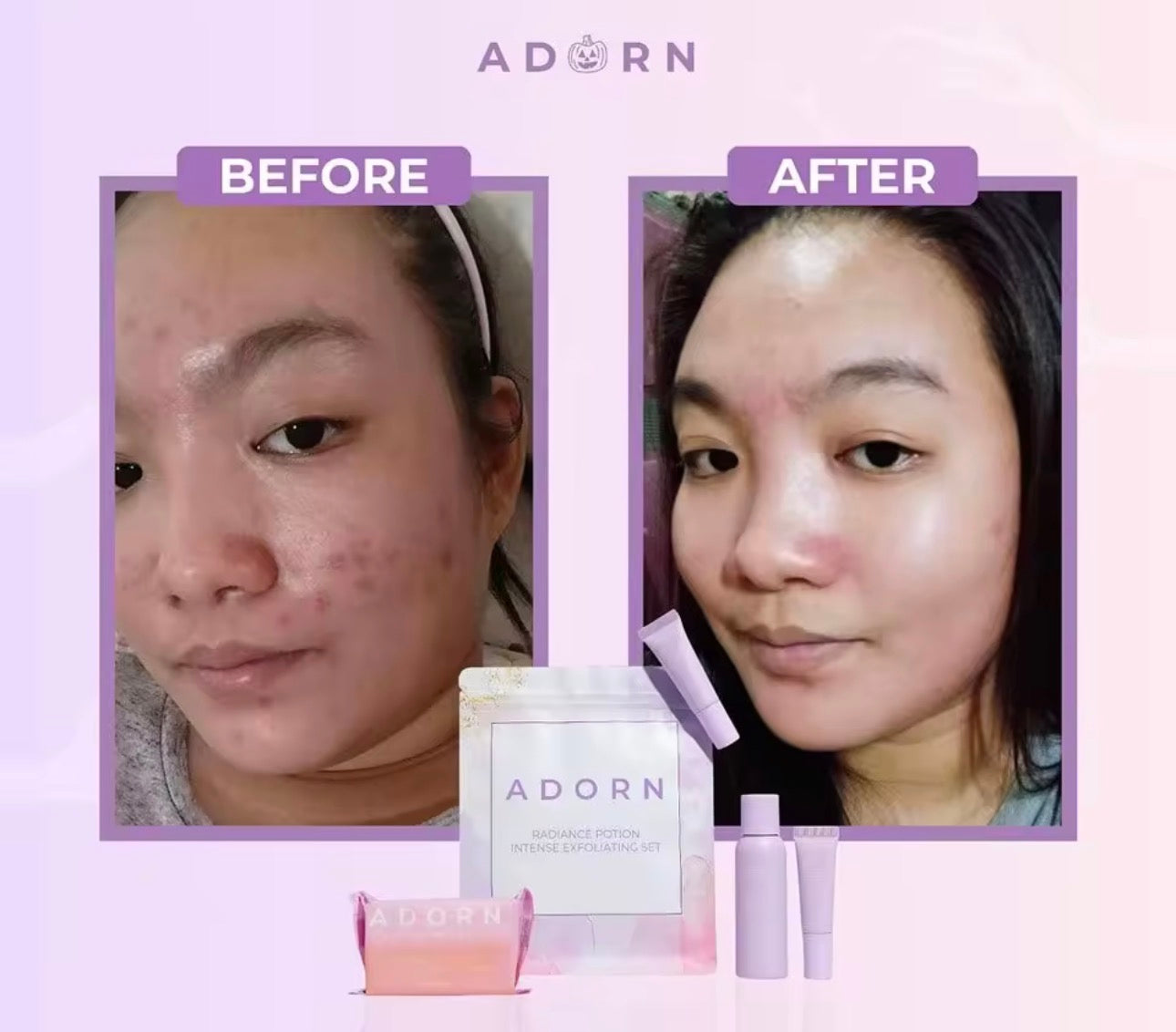 ADORN Intense Exfoliating Set | Rejuvenating set