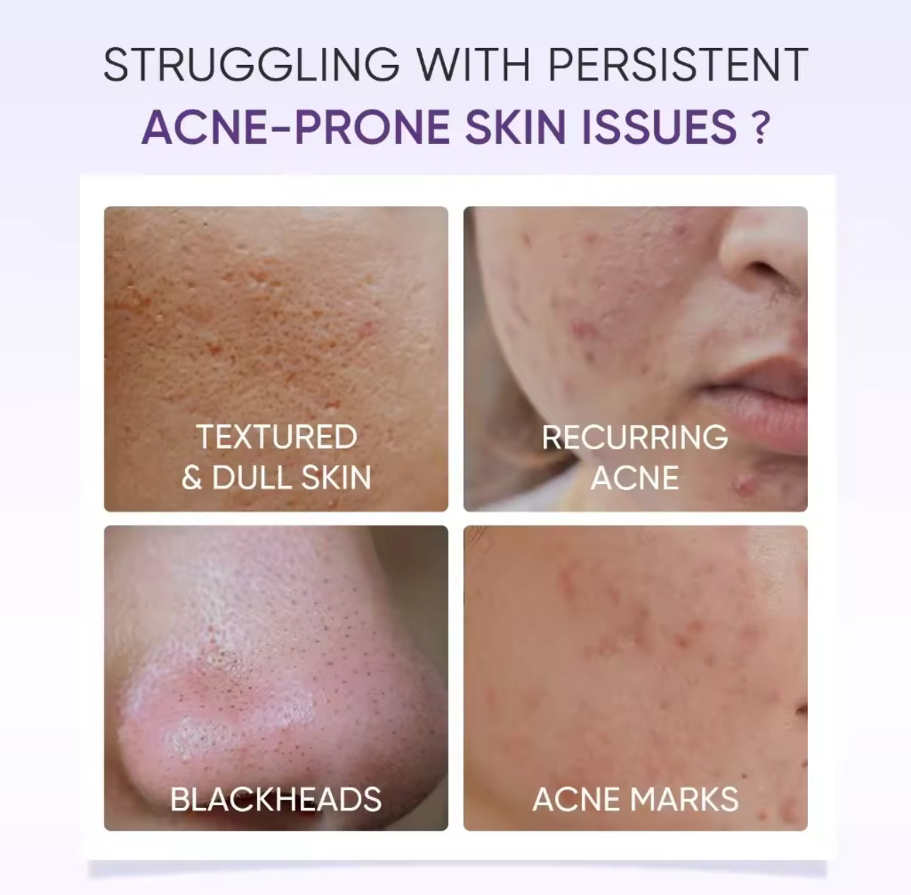 SKINTIFIC Lactic Acid Skin Renewal Exfoliating Anti Acne&Pores Serum 20ml Skin care