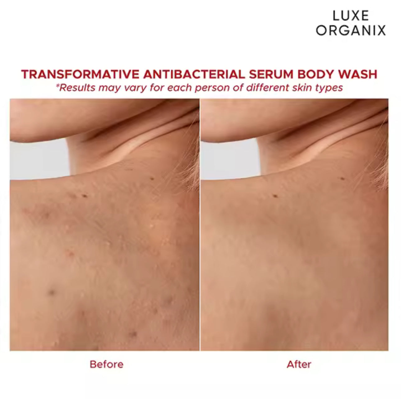 Luxe Organix Dermapro Salicylic Acid 2% Acne Rescue Serum Antibacterial Body Wash 500ml