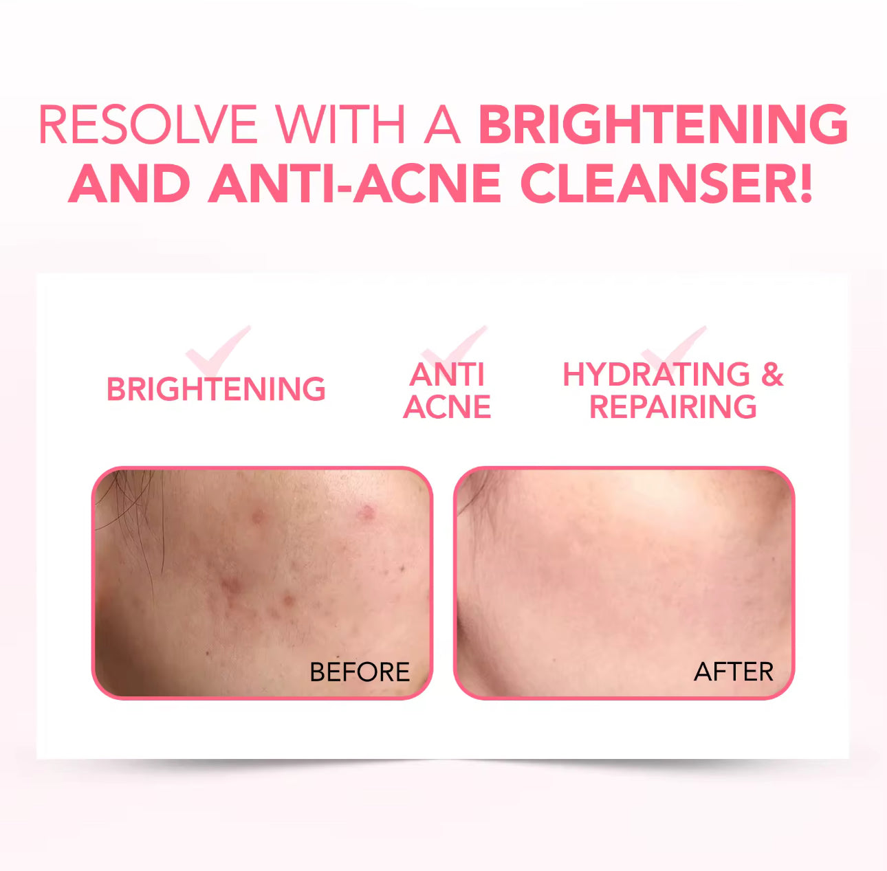 Y.O.U Hy! Amino Glowing Acne Calming Deep Cleanser l Radiant Skin and Acne Calming l 100ml